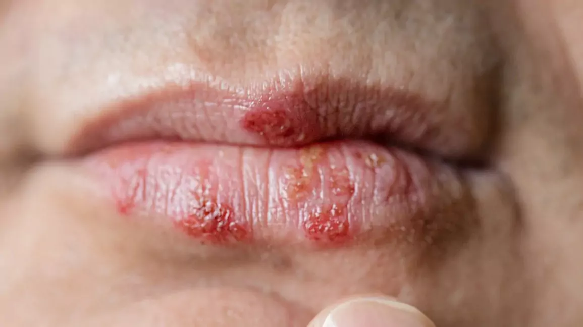 herpes treatment